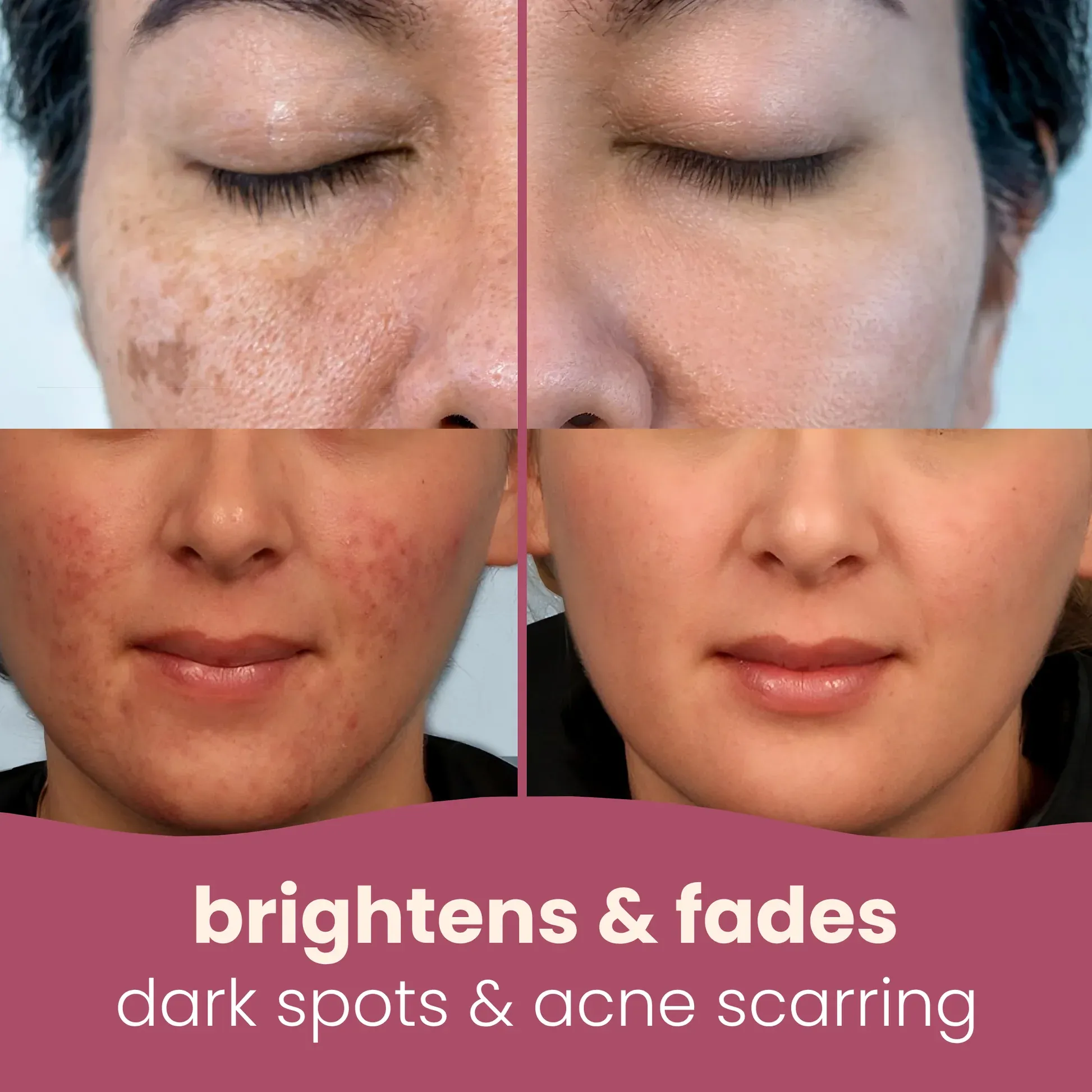 imgi_7_melasma-transformed_1_1_5